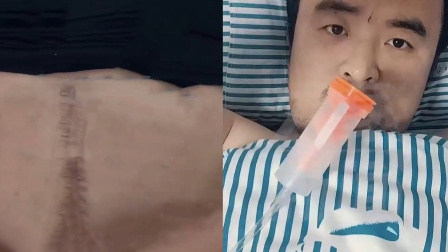 男子从电诈园区逃生后成反诈志愿者，通过露出身上伤疤劝退很多人