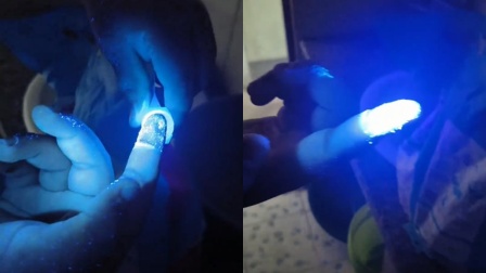 孩子白癜风用紫光灯治疗，意外照出全家